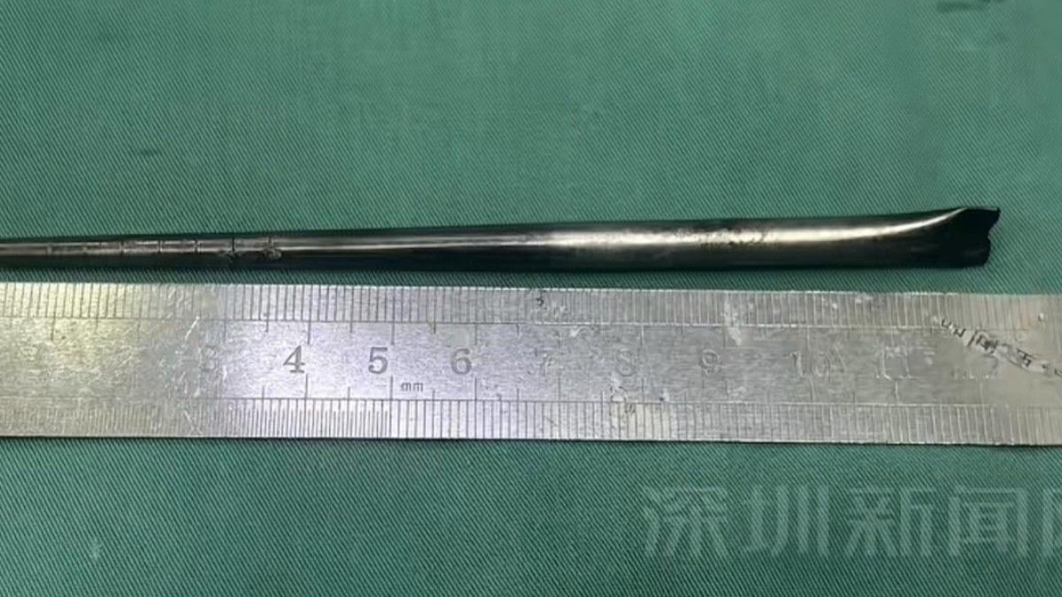 鐵塊待在男子咽部長達半年,醫師利用微創手術取出。(圖/翻攝自海報新聞)