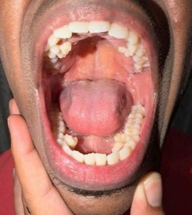 馬來西亞33歲男子穆尼亞迪(Prathab Muniandy)擁有42顆牙齒,比正常成年人多出10顆