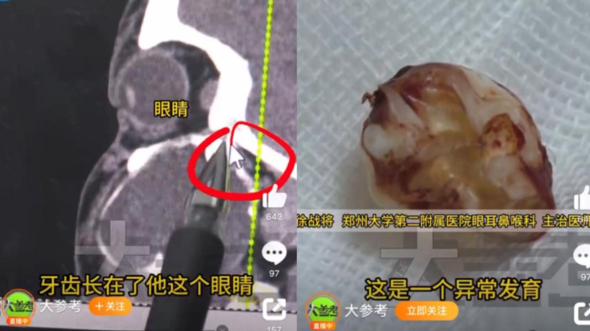 罕見!陸少年「臉歪又腫」媽以為變胖 CT一照驚:智齒長在眼窩