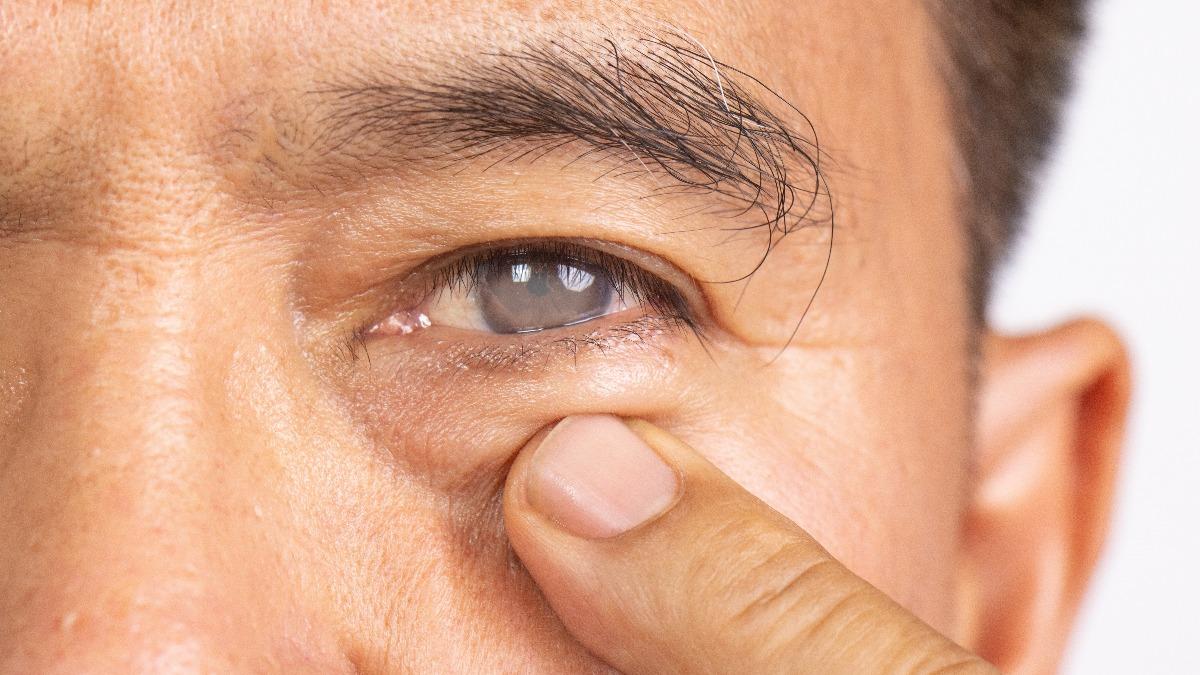 夜間開車視線糊小心!66歲男驚罹「白內障」 4症狀快就醫