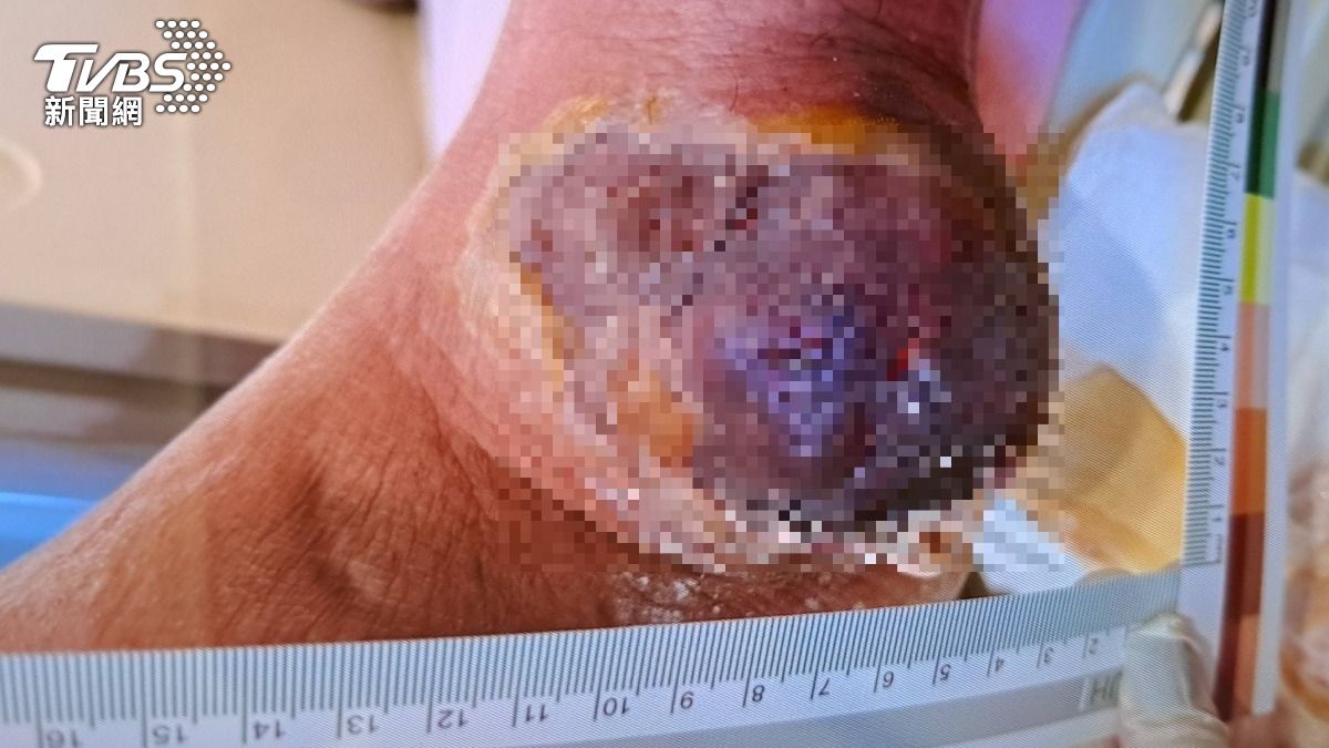 長雞蛋大痛風石「爆漿」!男司機腳踝破裂 醫警告:險截肢