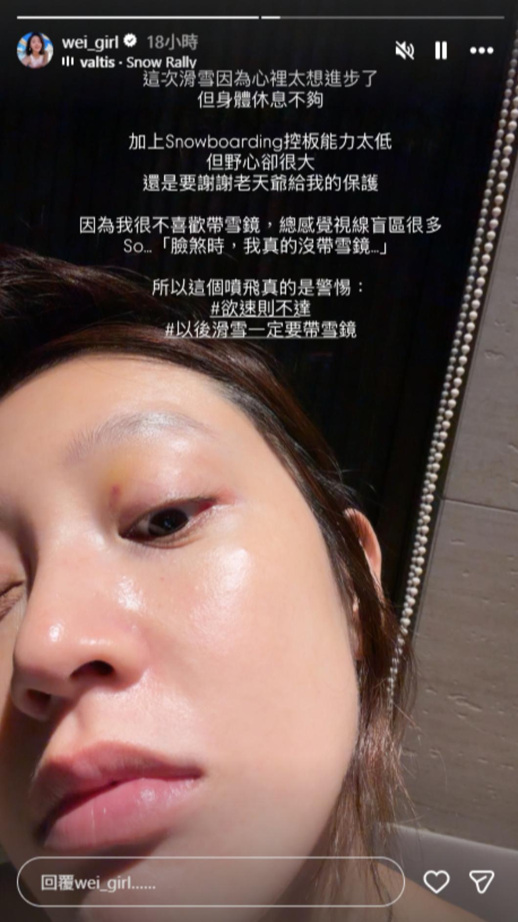 黃薇渟眼傷尚未痊癒。(圖/翻攝自IG)