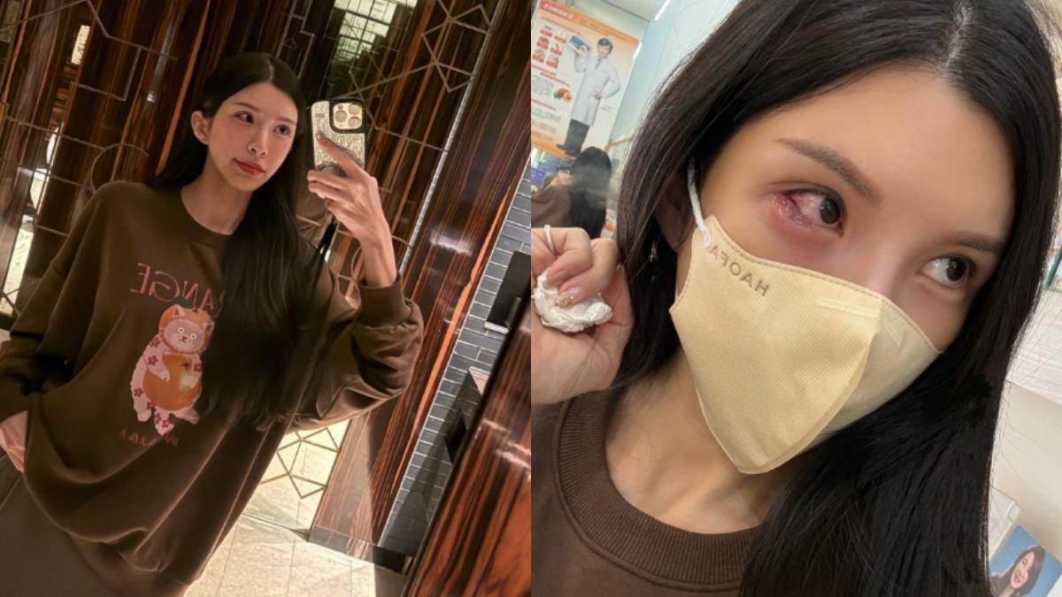 5天看3間眼科!「國光女神」自爆長針眼 痛到崩潰大哭大叫