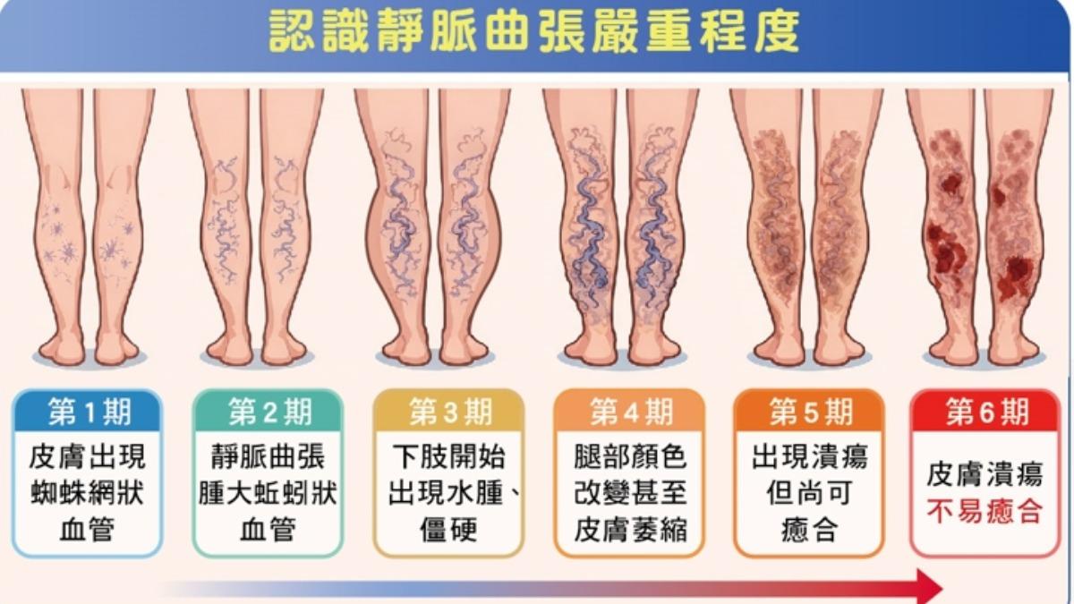 靜脈曲張分期。(圖/烏日林新醫院提供)