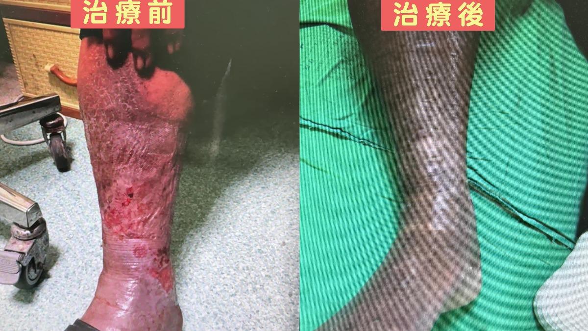 腳冒「蚯蚓」又潰瘍!台中翁拖半年皮膚黑到發紅 4類人小心