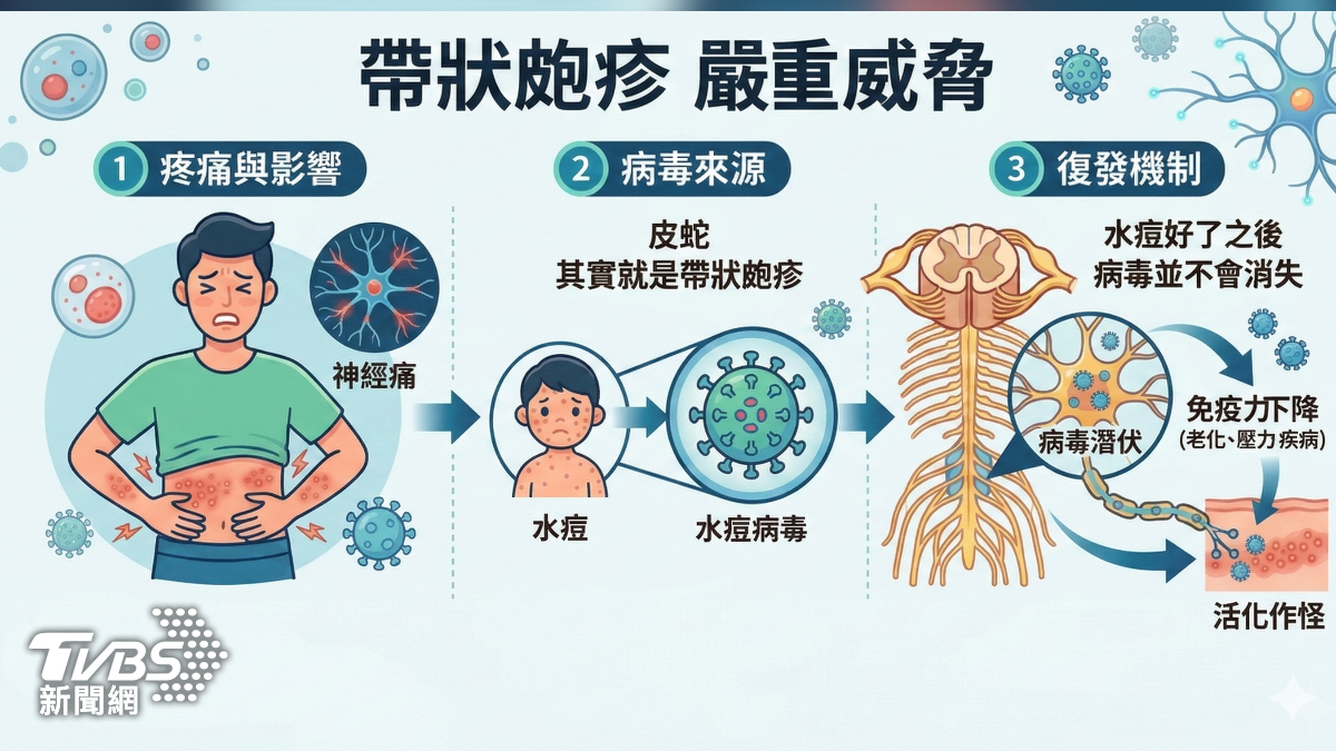 五十歲以上防皮蛇 醫:及早評估施打疫苗 (圖/TVBS)