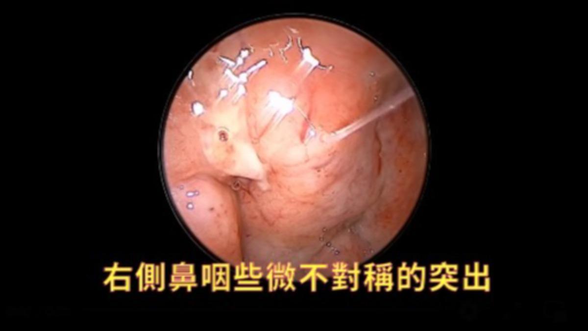 男鼻塞以為鼻竇炎!醫揪「1處不對稱」確診鼻咽癌 初期4症狀曝