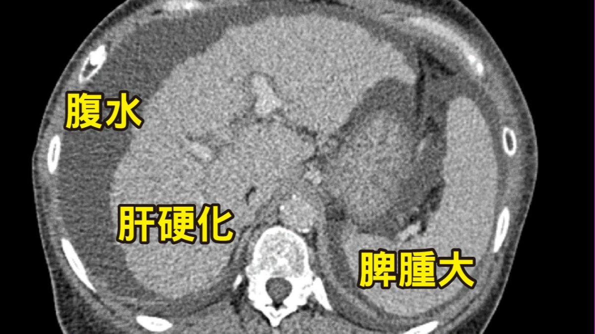 患者嚴重肝硬化。(圖/醫院提供)