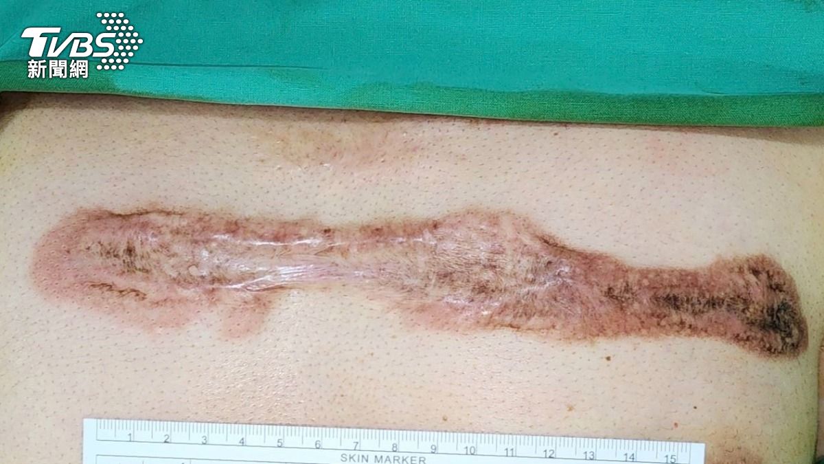 手術後疤痕變凸又發癢?小心肥厚性疤痕與蟹足腫 (圖/TVBS)