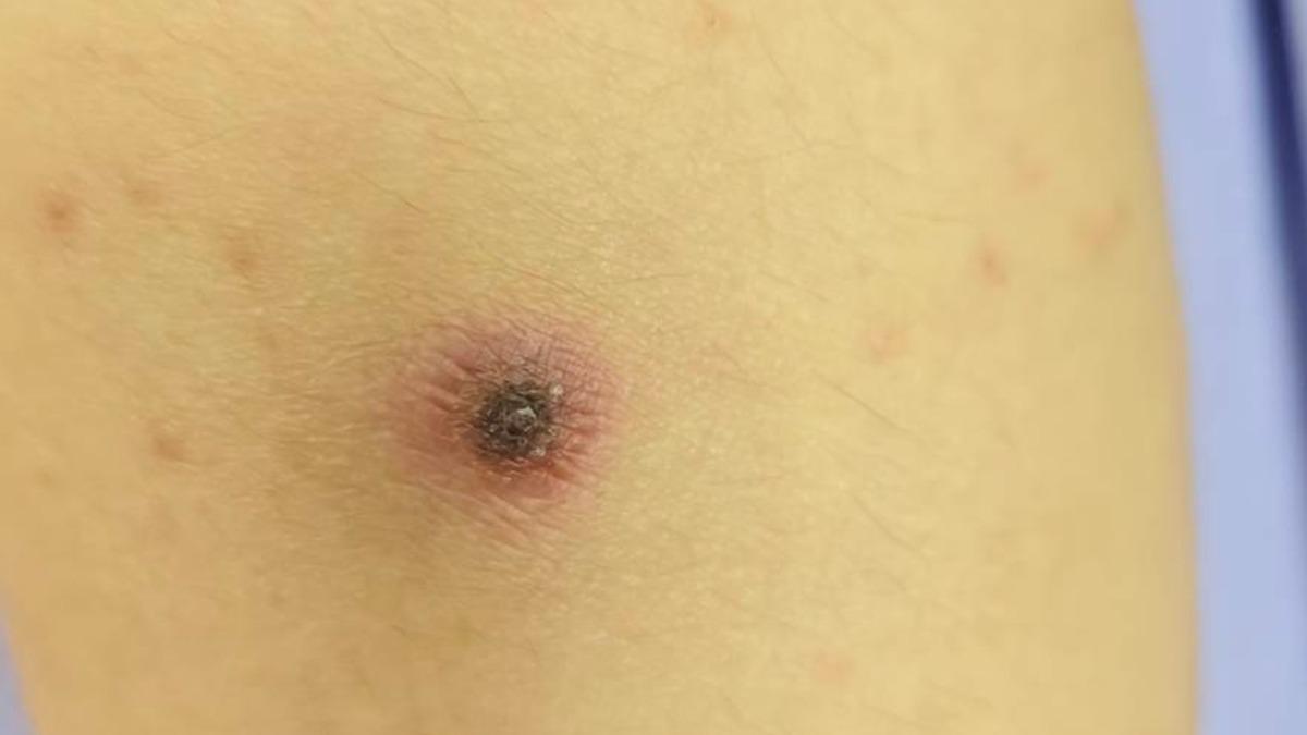 露營完高燒39度!12歲童腿藏「神祕焦痂」 醫:嚴重恐衰竭