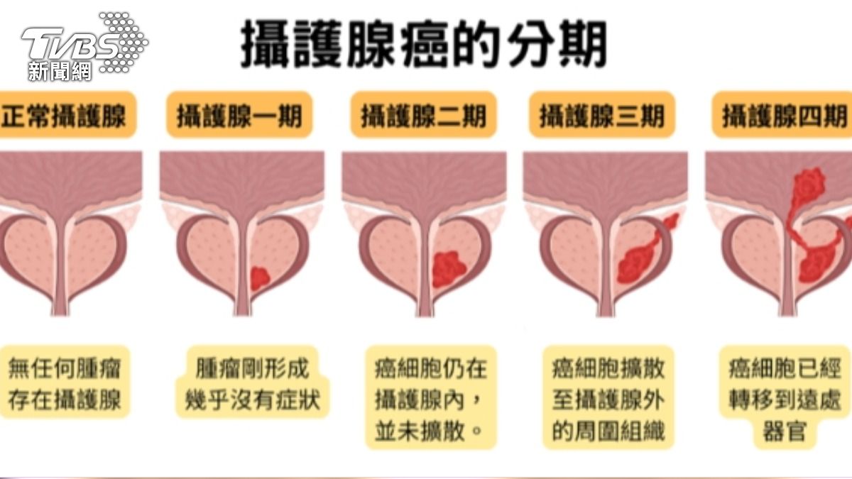 林孟嚴補充攝護腺癌分期。(圖/TVBS,請勿任意翻攝)