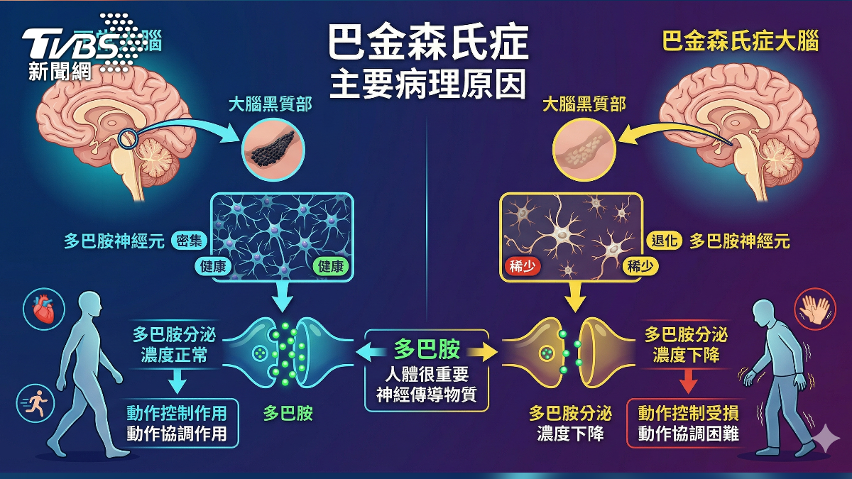 巴金森氏症不只會手抖!醫揭4大典型症狀與治療關鍵!(圖/TVBS)