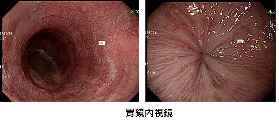長期下來食道像氣球般被撐大、變形。（圖／TVBS）