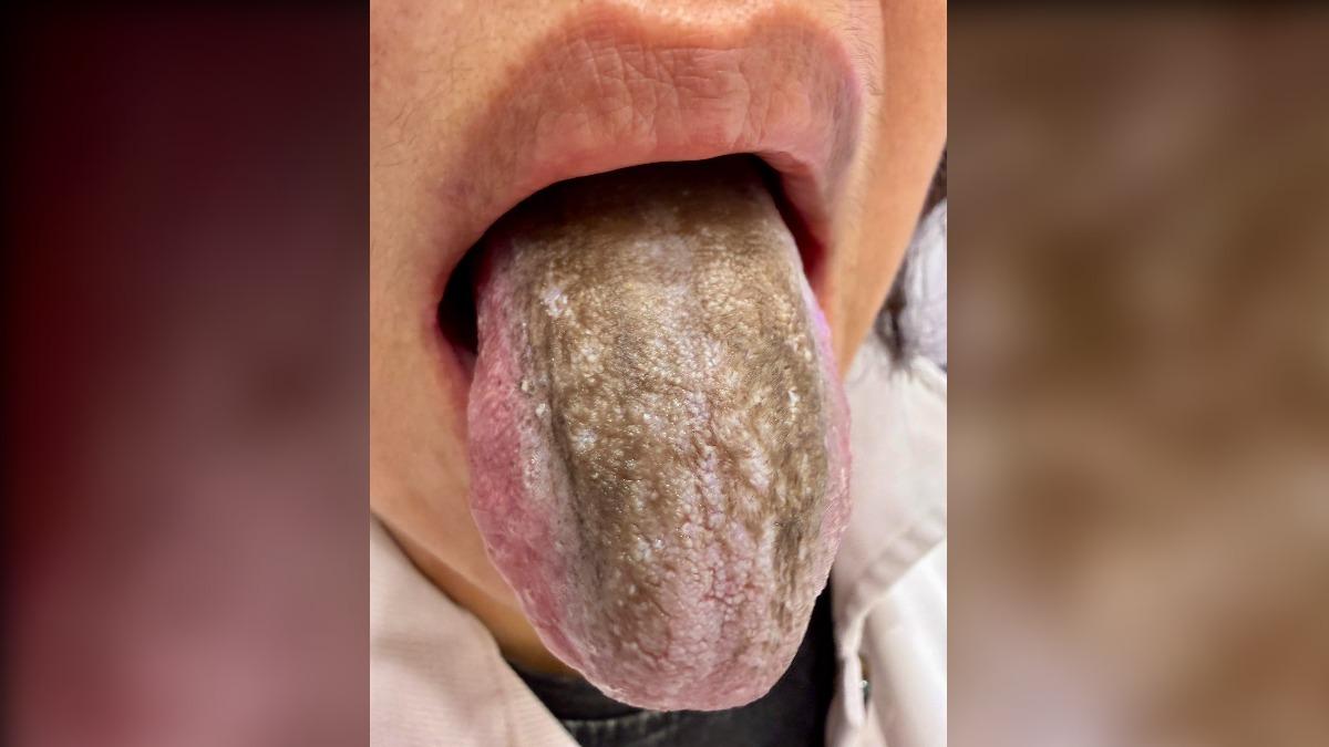 婦人一天漱口6次!舌頭長「整片黑毛」 醫:細菌已落地生根