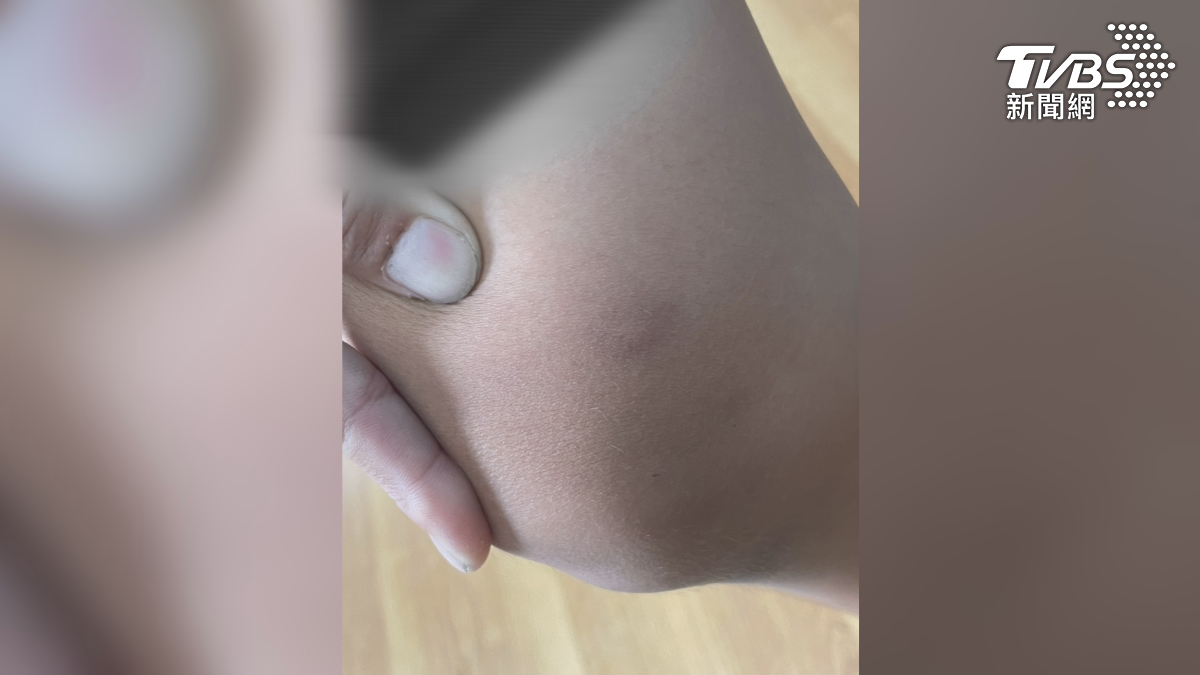小六生秀出膝蓋上的傷勢，有著明顯瘀青，媽媽怒控孩子遭到學校老師霸凌（圖／TVBS）
