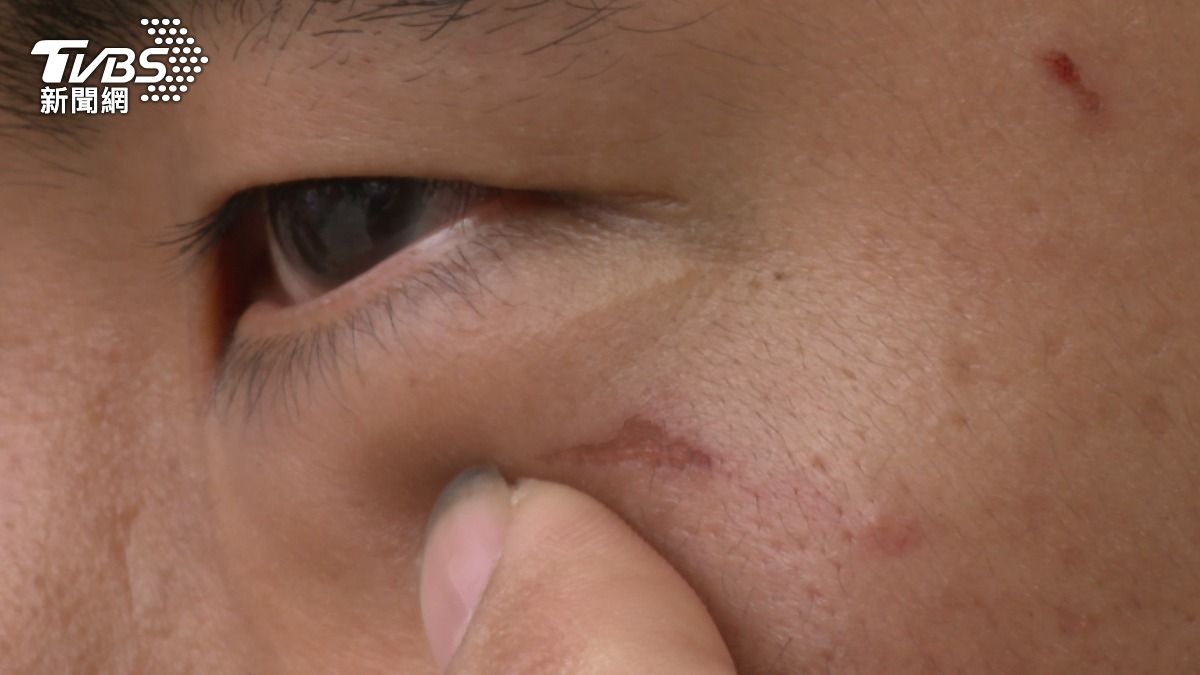 一中街不讓道起衝突!駕駛控「往死裡打」眼眶骨折,視力恐受損。(圖/民眾提供)