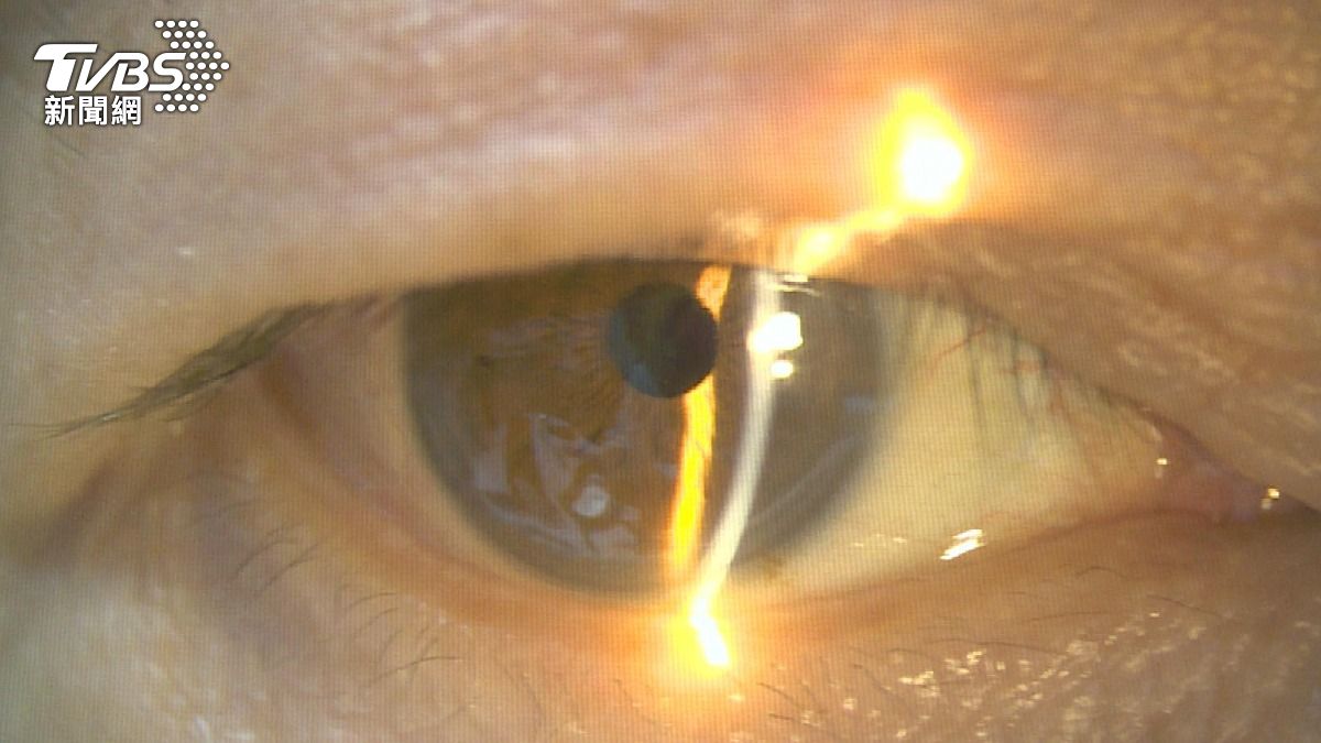 眼睛顏色藏健康密碼?醫師解析虹膜變化與疾病風險關聯 (圖/TVBS)