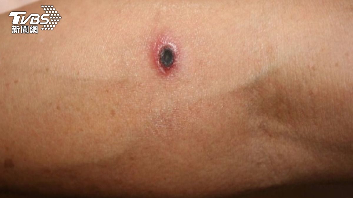 掃墓完身上突冒「無痛黑痂」!醫示警恙蟲病8症狀:致死率60%