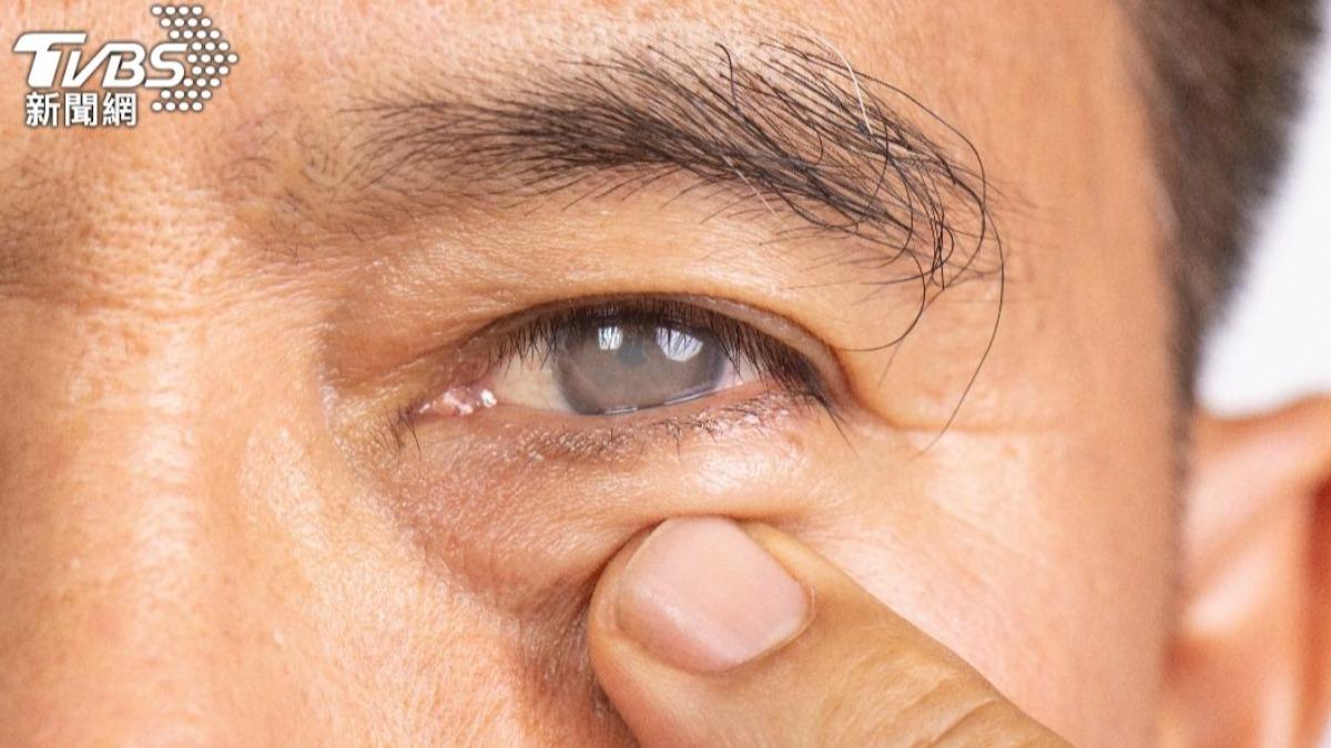 糖尿病眼睛出問題！恐是「失智」前兆　醫：4症狀要當心