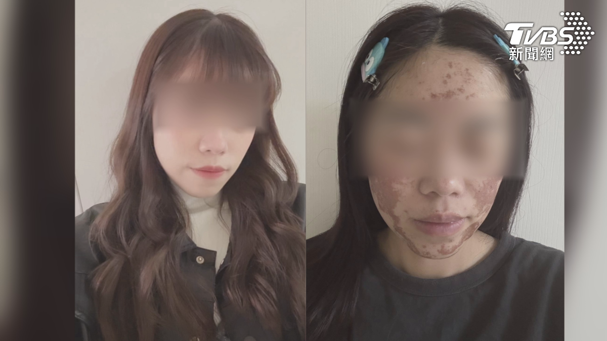 高雄一名陳小姐第一次接受果酸煥膚療程,遭美容師誤用70%果酸,導致額頭、臉頰到下巴出現明顯灼傷,臉部嚴重受損(圖/民眾提供)
