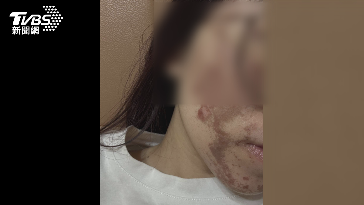 陳小姐表示過程中感到強烈灼熱疼痛,事後才得知美容師拿錯濃度(圖/民眾提供)