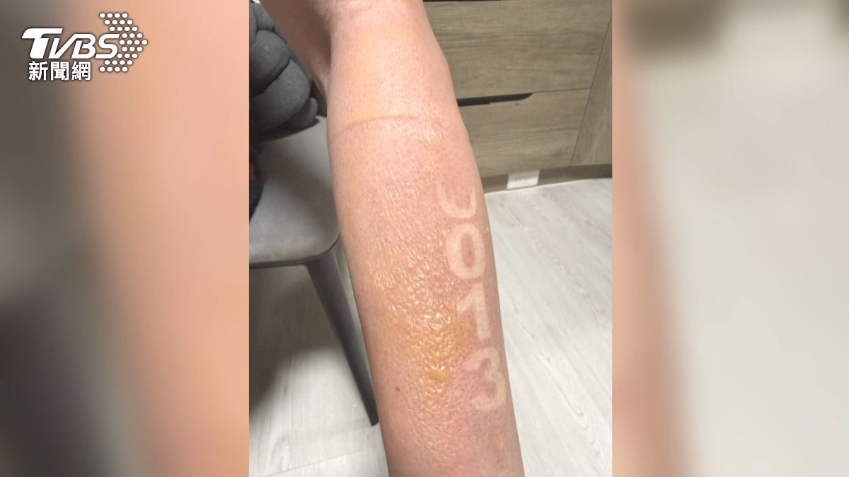 當紗布拆下後,可見小手臂上清晰烙印著參賽號碼「0013」,形成特殊的鐵人印記。(圖/民眾提供)