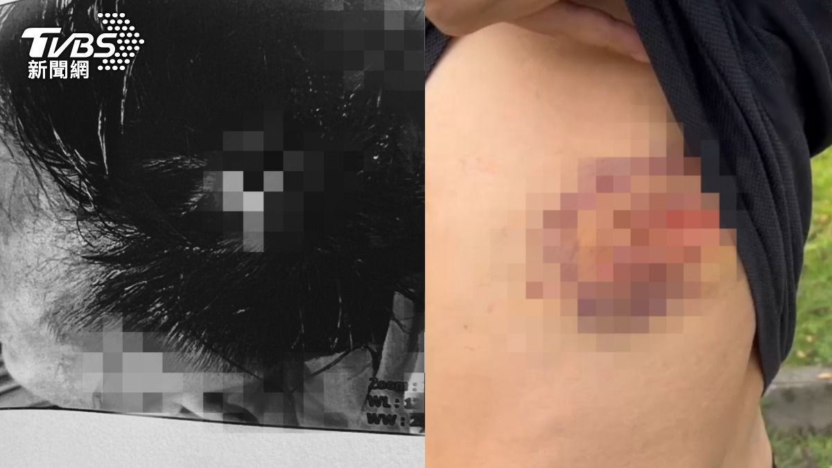 宜蘭情侶爆口角！男子遭女友哥「鋁棒狂毆」　頭縫14針濺血