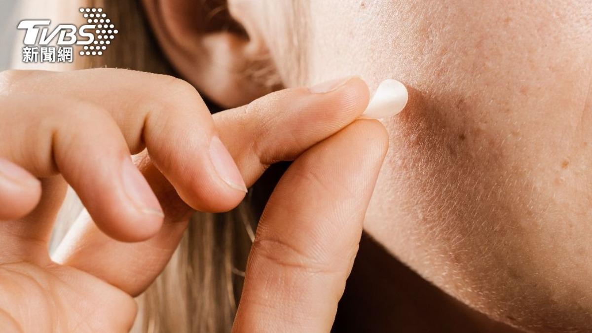 貼錯悲劇了!「這3種痘」別貼痘痘貼 皮膚醫示警:恐惡化爛臉