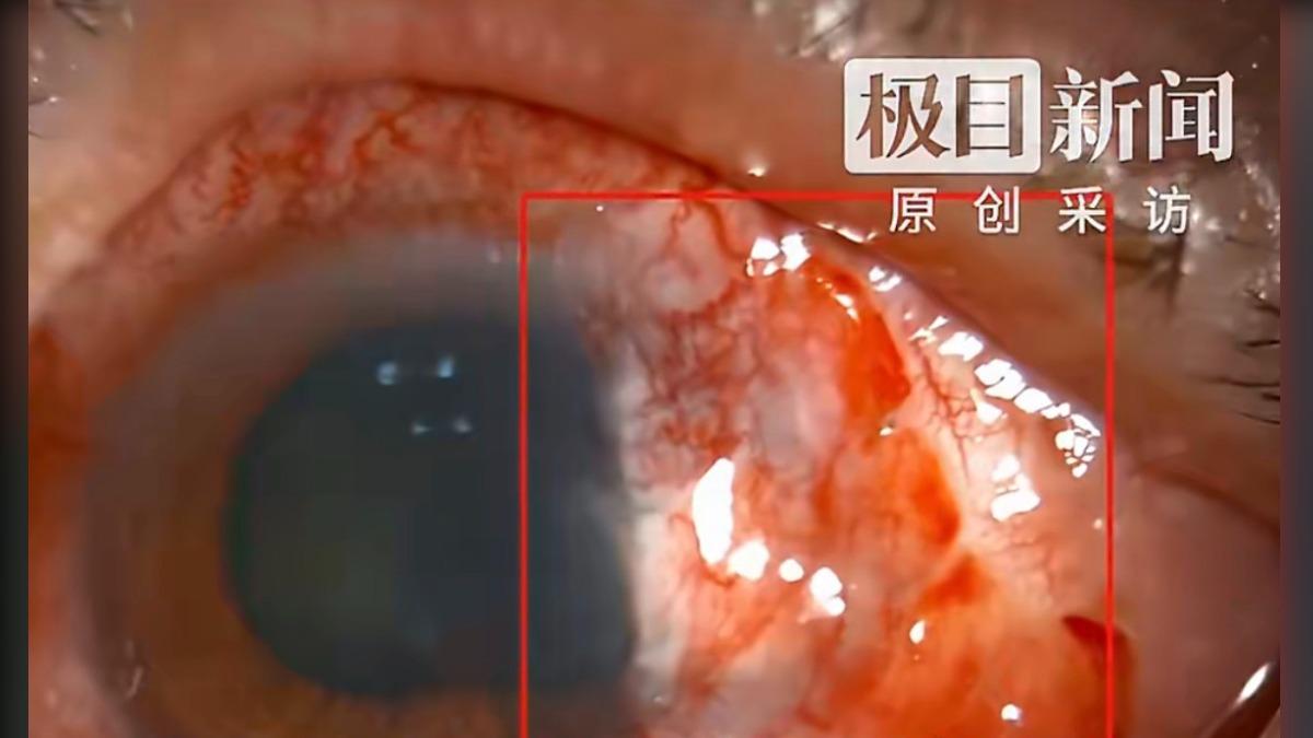 中國福建一名男子未理會跑進眼睛的蚊蟲,10天後竟出現紅腫、疼痛,視力僅剩0.04。(圖/翻攝自微博)