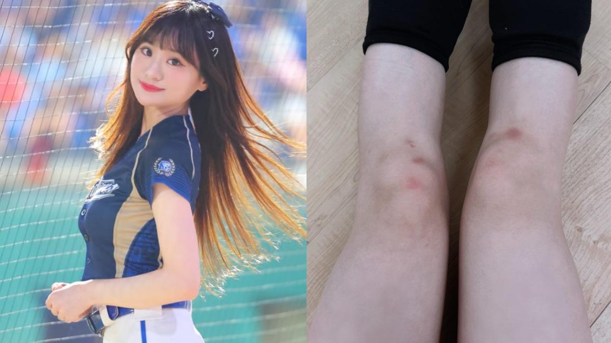 隱忍1個月!富邦啦啦隊女孩證實「半月板、韌帶撕裂」 曬膝蓋驚人傷勢
