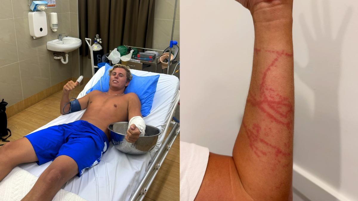 澳男遭最毒水母螫傷!手臂像被熱油潑 呼吸困難問:我會死嗎?
