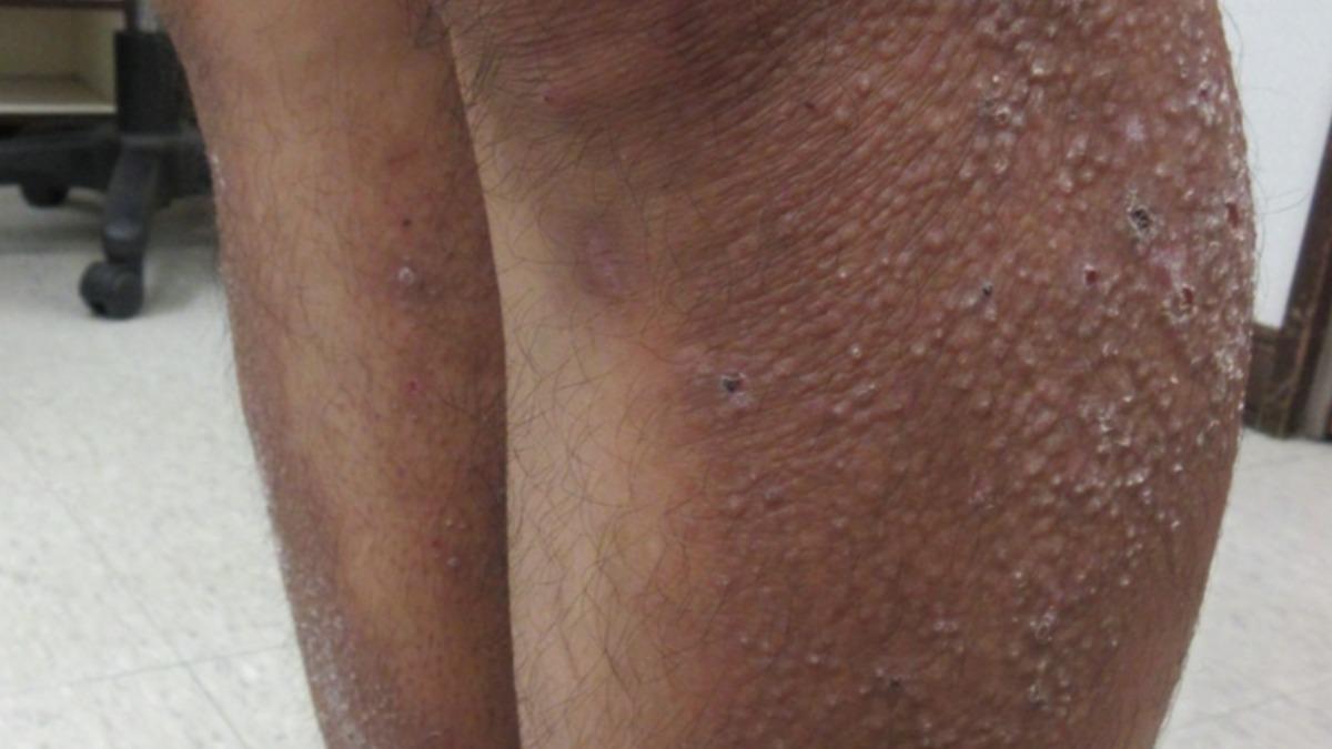 男子的右小腿皮膚像癩蛤蟆般。(圖/黃麗珊醫師提供)