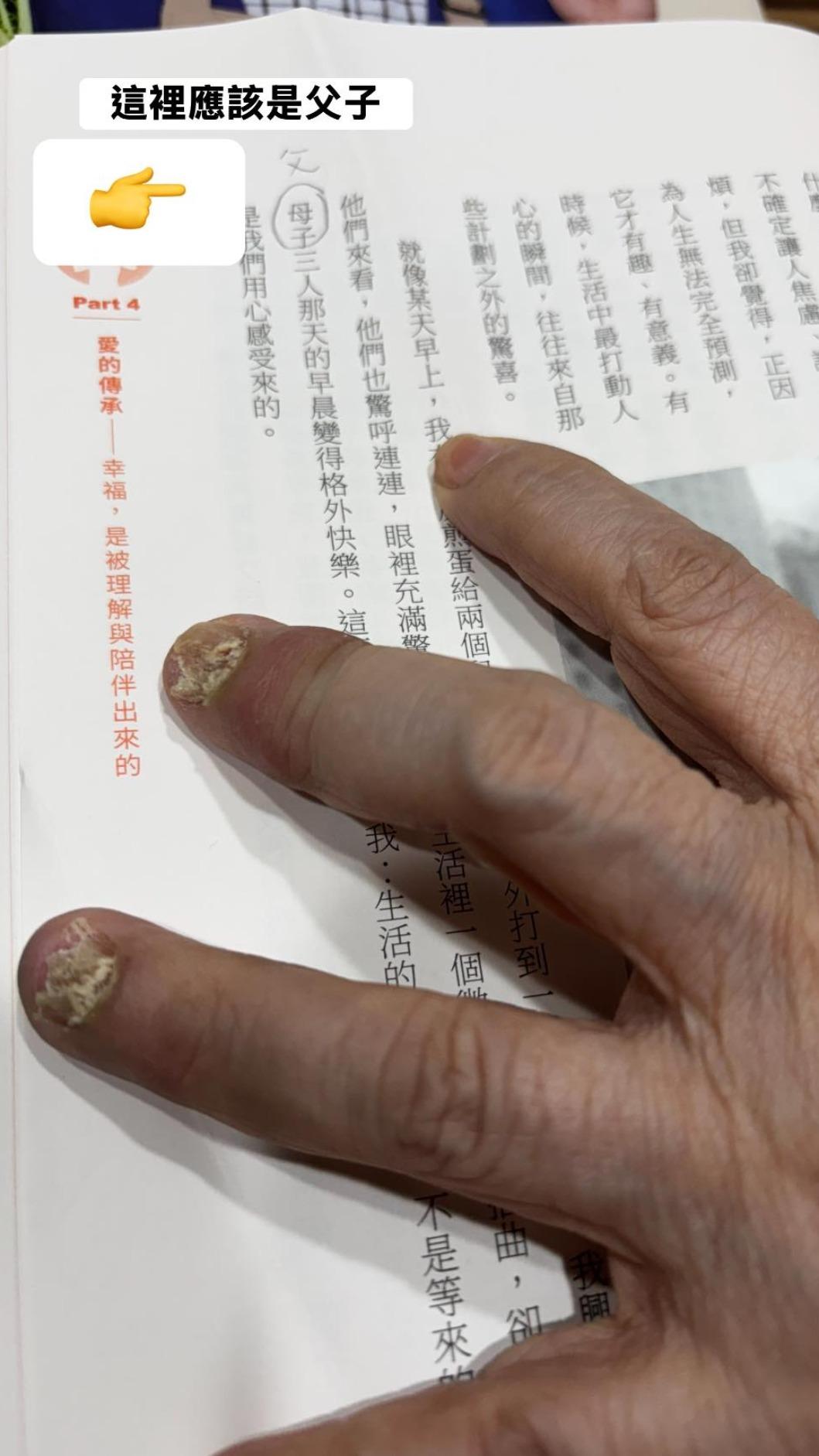 黃越綏手指黴菌感染。(圖/翻攝自狄志為臉書)