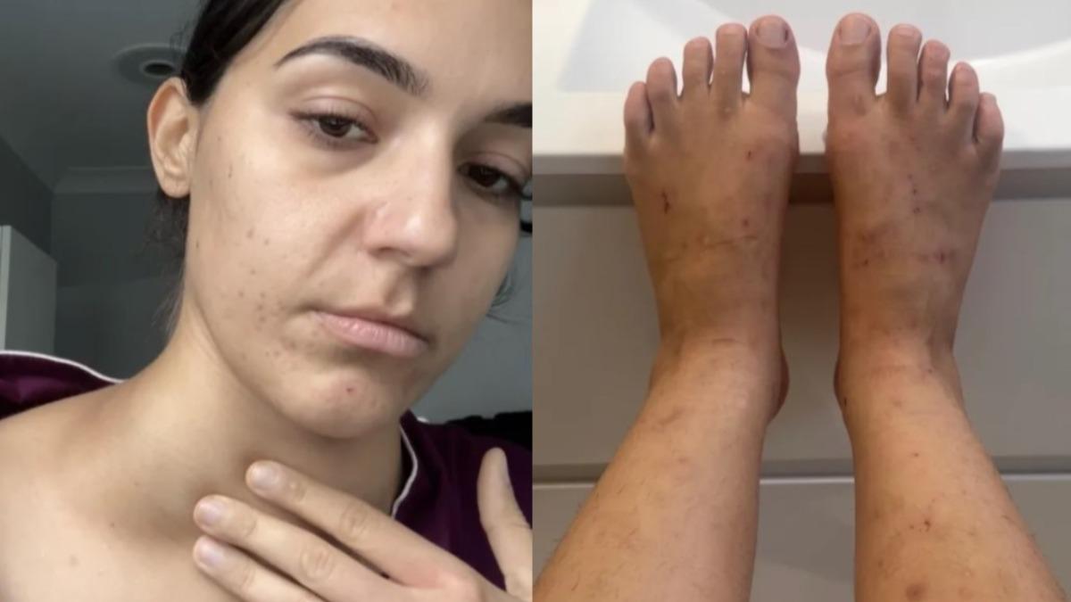 26歲澳女盜汗、癢到睡不著!醫師稱皮膚乾「保濕就好」一驗竟罹癌