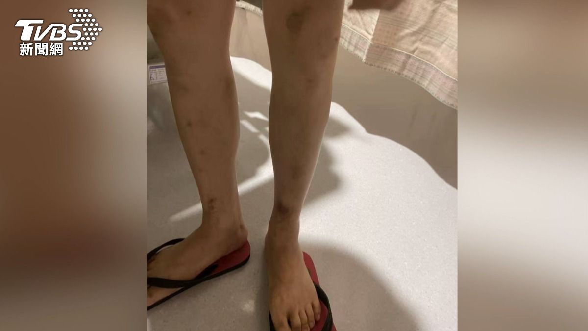 林姓男子返台後身上仍留有明顯傷痕，他指出雙腳都有勒痕，是被綁手綁腳造成的痕跡。（圖／TVBS）