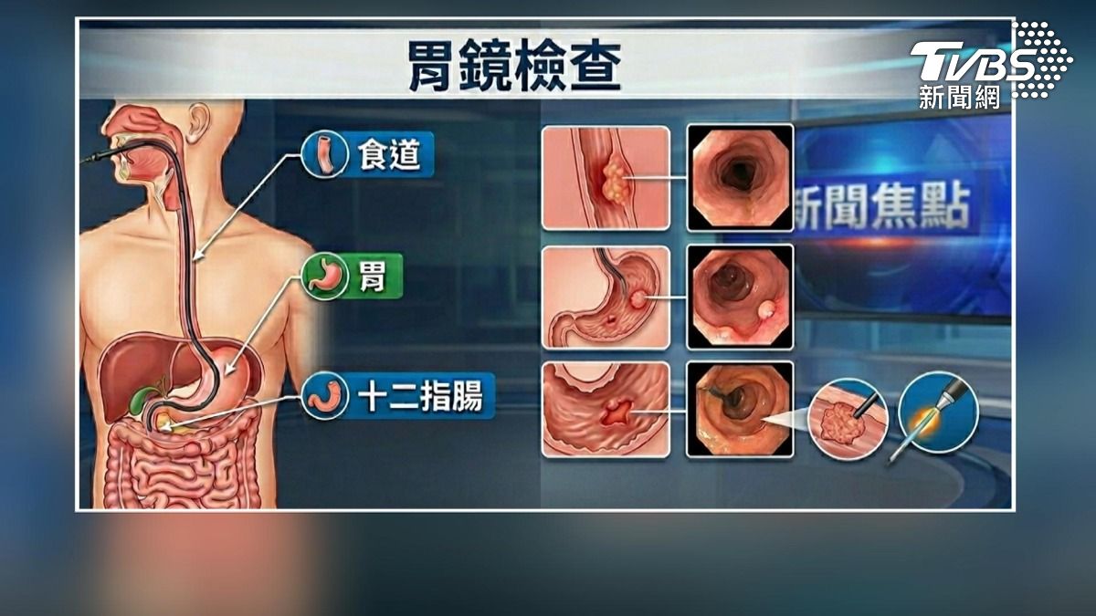 46歲男做胃鏡竟喪命!高大成揭死因。(圖/TVBS)