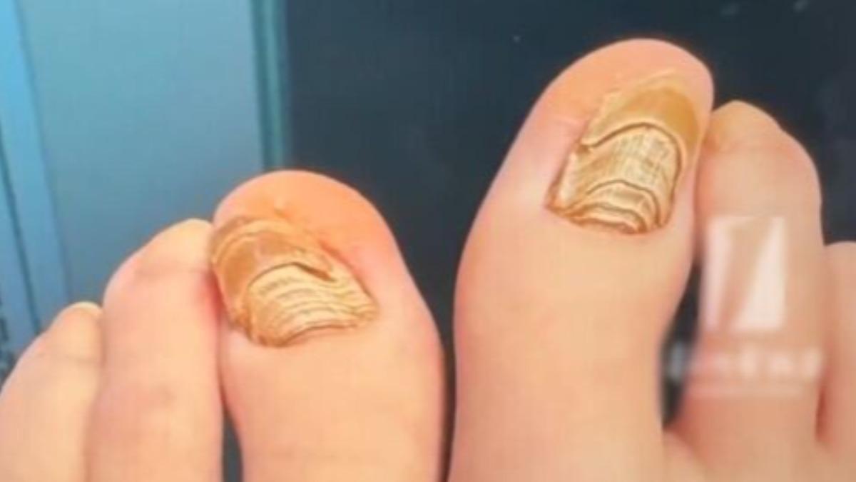 睡覺穿襪出事!陸女「腳趾甲像千層蛋糕」 醫嘆來太晚:整片拔掉