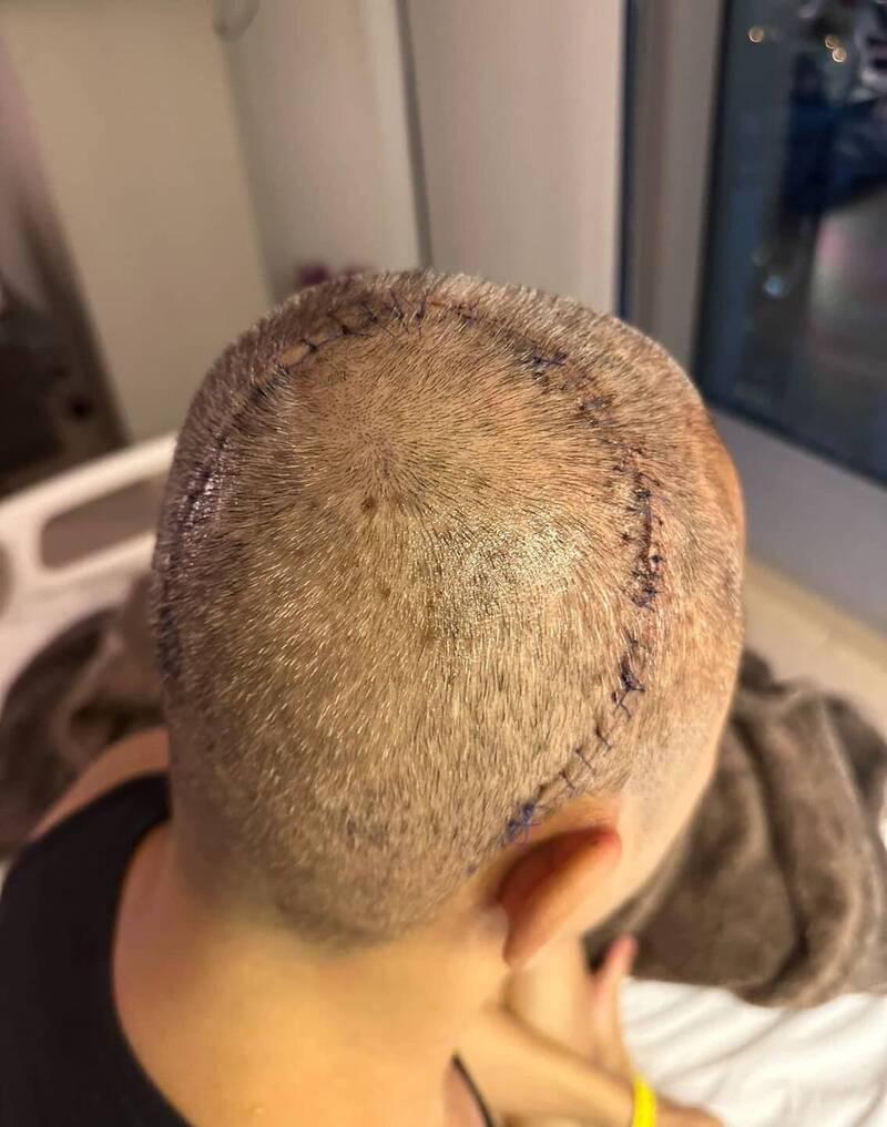 蔡一傑,草蜢蔡一傑,蔡一傑腦癌,蔡一傑腦瘤,蔡一傑開腦,蔡一傑開顱,腦癌