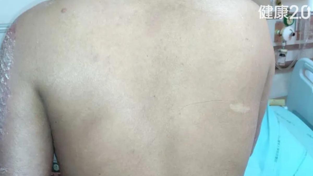 罕見病例!24歲男染新冠竟誘發「膿疱乾癬」 長滿上半身