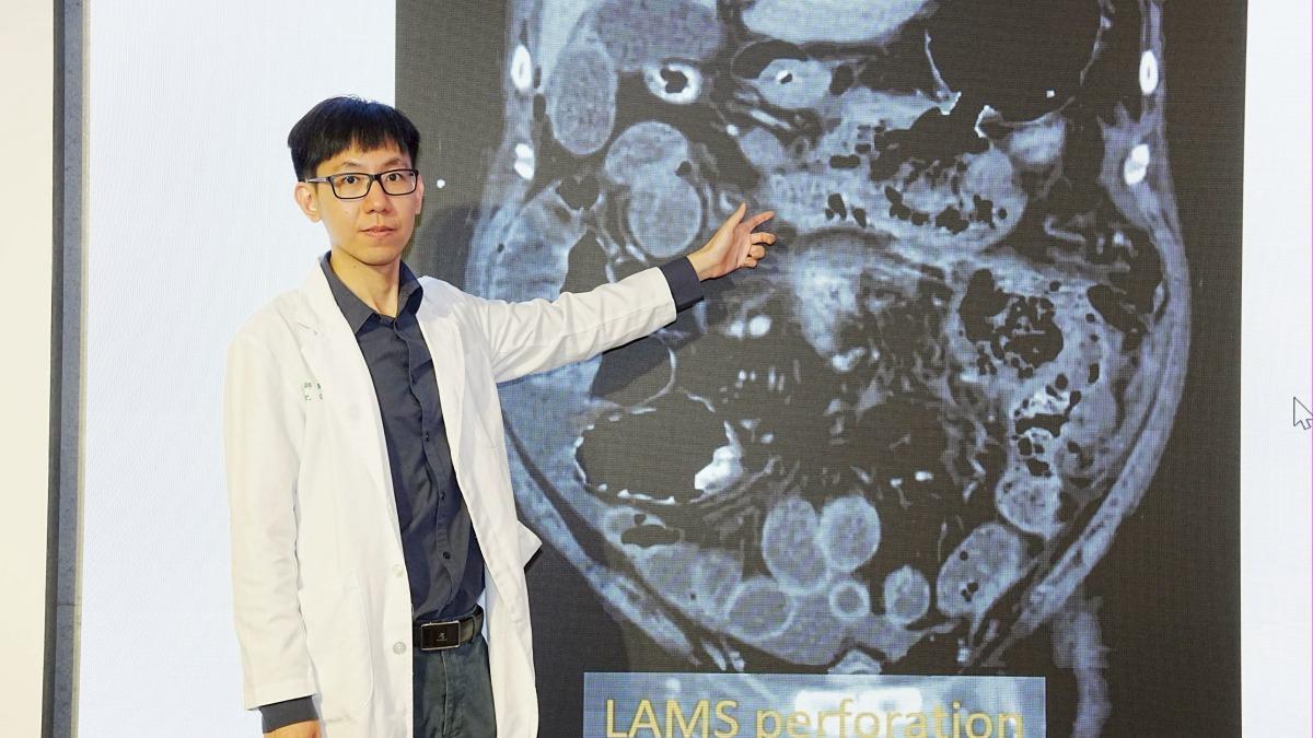 以為胃脹氣!39歲男膽結石引發胰臟壞死 醫揭死亡率達6成
