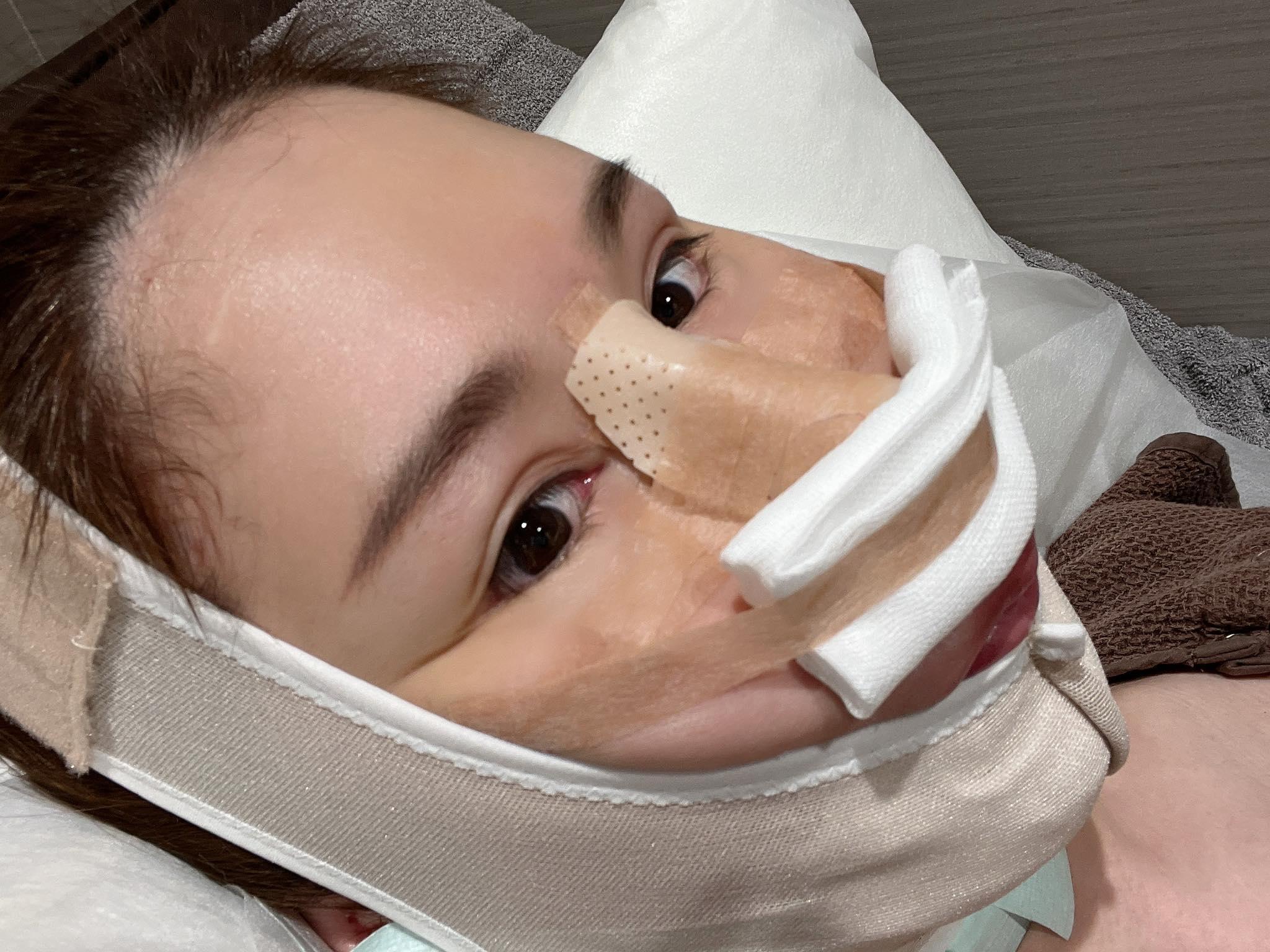 臉部多處動刀的辛尤里坦言,麻醉退了之後比生產還要痛。(圖/翻攝自辛尤里臉書)