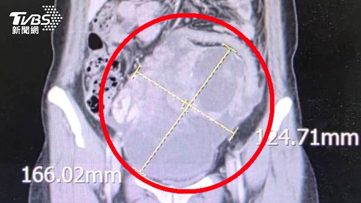 腹脹2週以為腸胃炎!44歲女一照驚見16cm巨瘤 確診罕見雙癌
