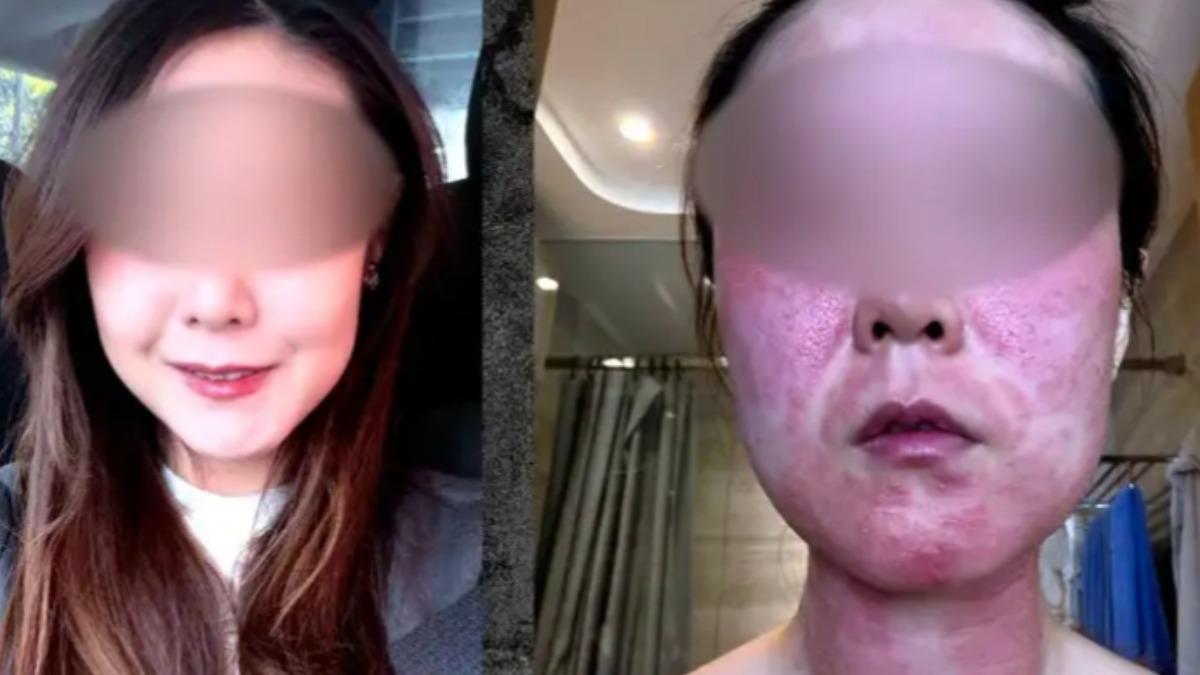 香港準新娘張小姐做完「美容微針」後,整張臉紅腫長滿白色膿包,和醫美前皮膚光滑的樣子判若兩人。(圖/TVB東張西望)