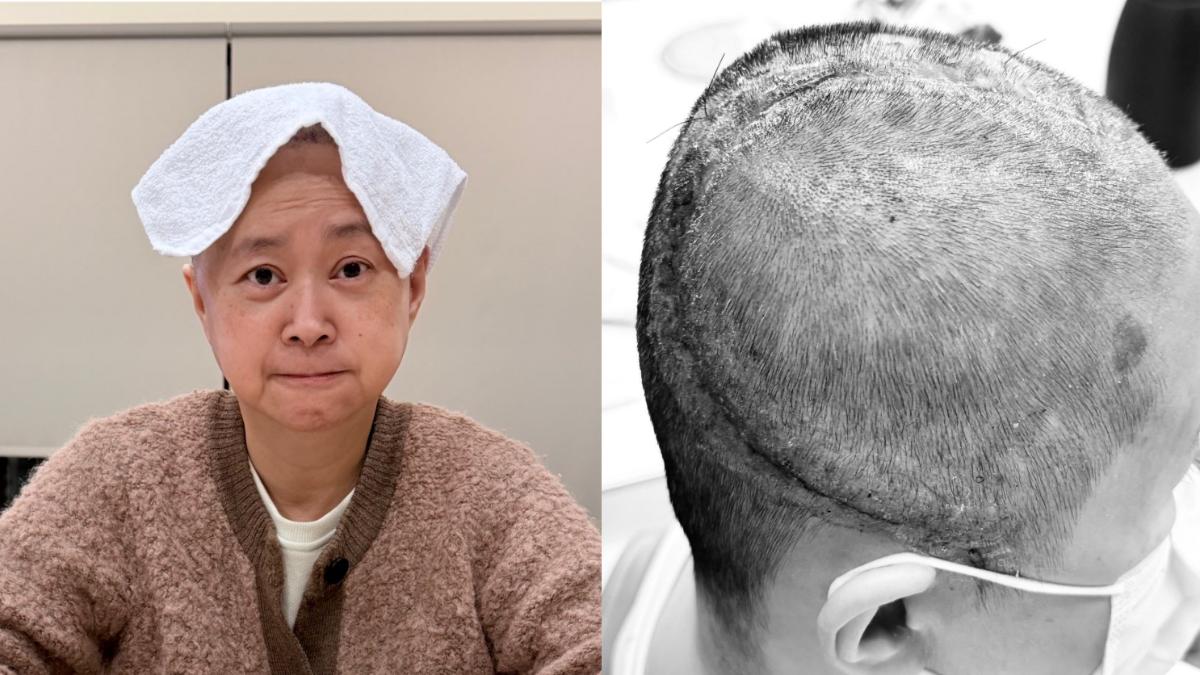 王月開顱搶命「蜈蚣長疤曝光」 剃平頭露面:生死邊緣走回來