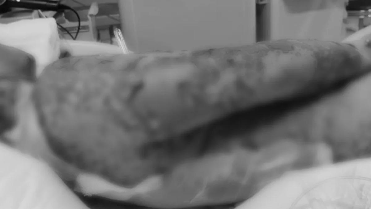 中國大陸一名男子酒後頭痛，吃3次止痛藥後全身超過95％皮膚潰爛。（圖／翻攝自齊魯電視台）