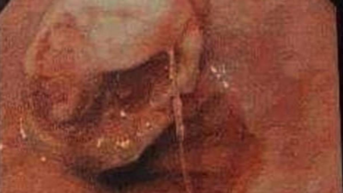 竹科工程師血便昏倒!揪出食道癌 醫:亞洲人基因缺陷易罹癌