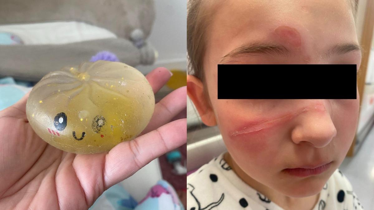 抖音挑戰出事!紓壓球「爆炸噴濺」 英10歲女童臉部灼傷送醫