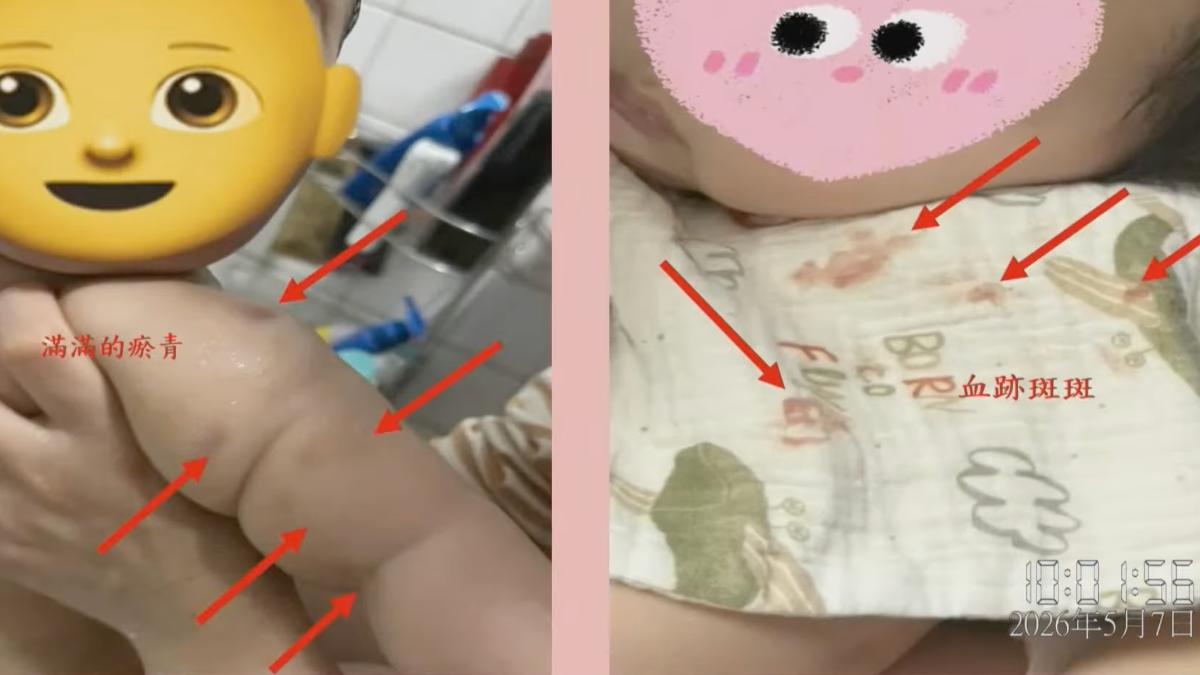 多名孩童遭虐待瘀青流血,甚至口水巾上血跡斑斑。(圖/翻攝自Youtube「嘉義市議會」)