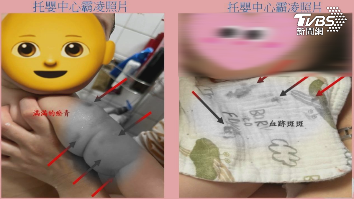 嘉義市一家私立托嬰中心,爆出集體不當對待嬰幼兒事件,一位托育人員一個月內對6名嬰幼兒施暴,造成孩童手臂瘀青,甚至嘴角流血!(圖/TVBS)
