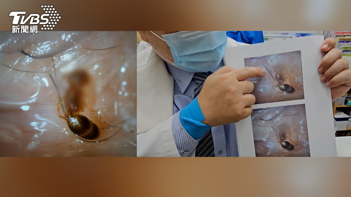 高雄一名8歲男童日前午睡時突然痛醒，左眼劇痛到在地上打滾，家長緊急送醫後，眼科醫師竟在男童左眼下眼皮發現一隻2.5毫米大的活螞蟻（圖／TVBS）